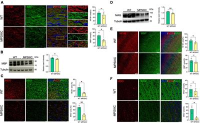 Severe central nervous system demyelination in Sanfilippo disease